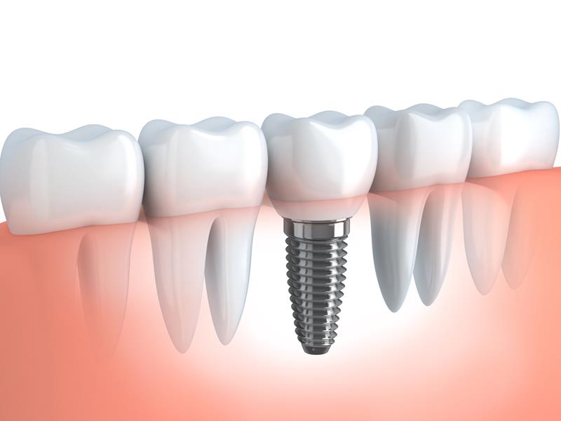 Dental Implants  Tucson, AZ 